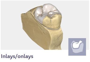 inlays onlays | CAD-Ray.com