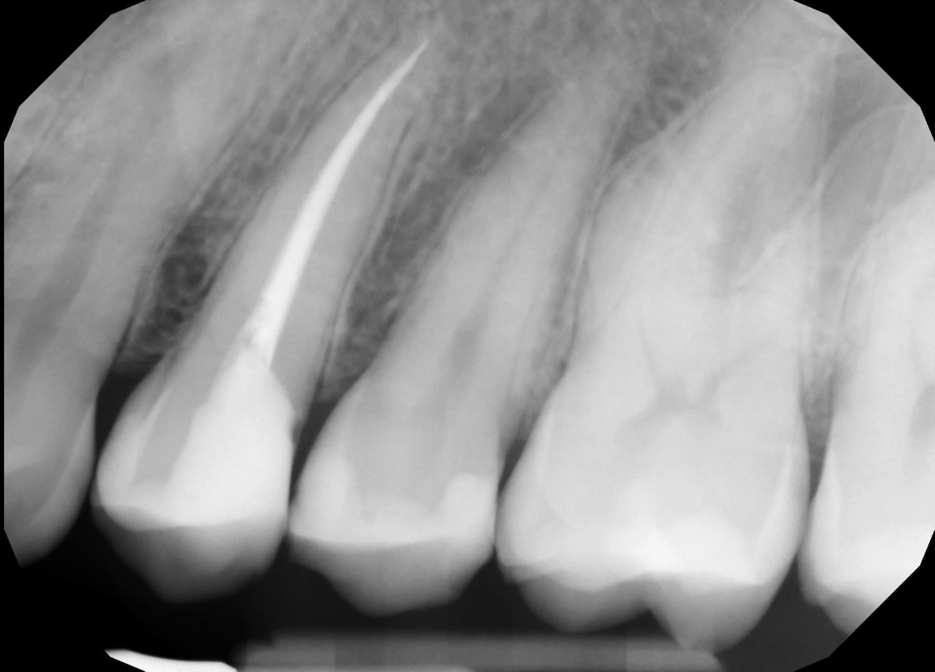 Periapical X Ray Of Premolar Prior To Crown Placement Cad Ray Com | My ...