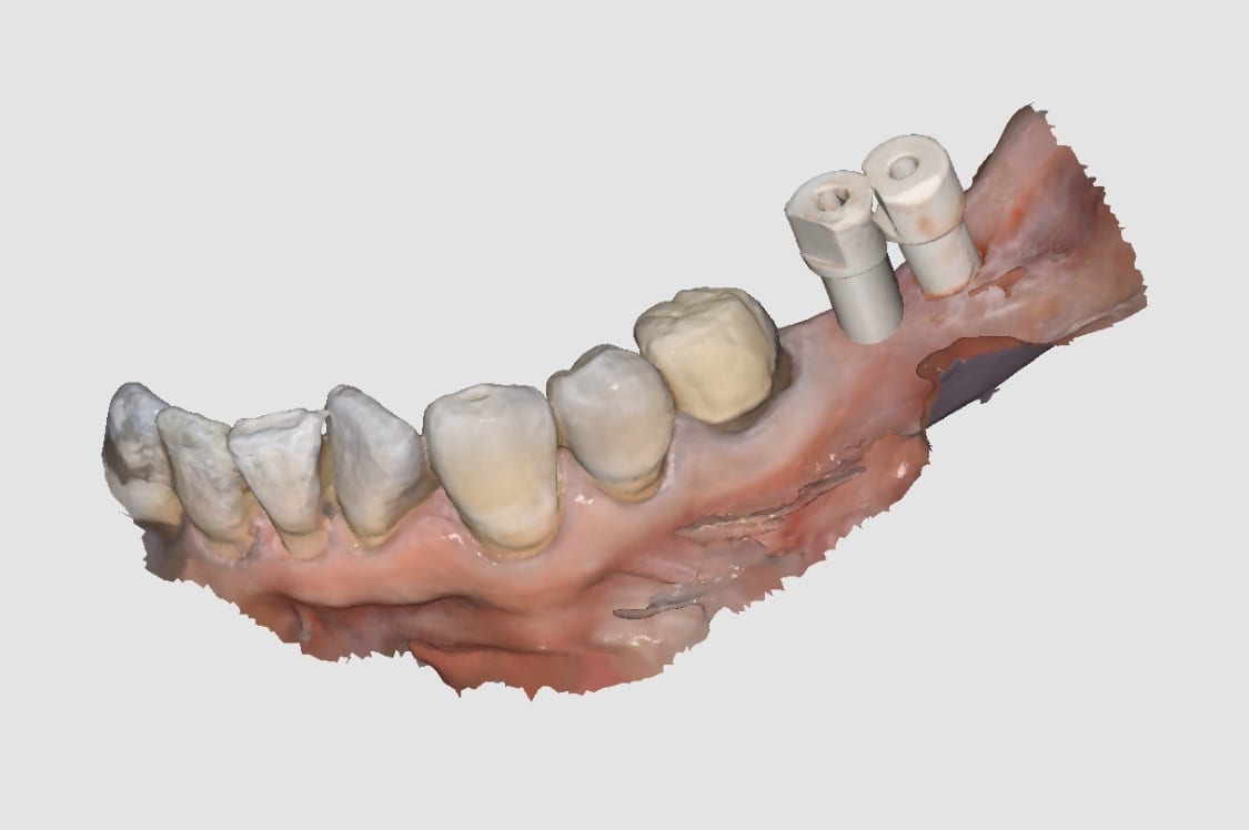 implant level impression dental