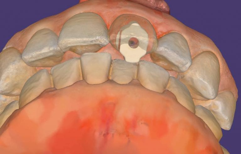 What Is An Implant Scanbody, Why Should You Use It, And Why You Need ...