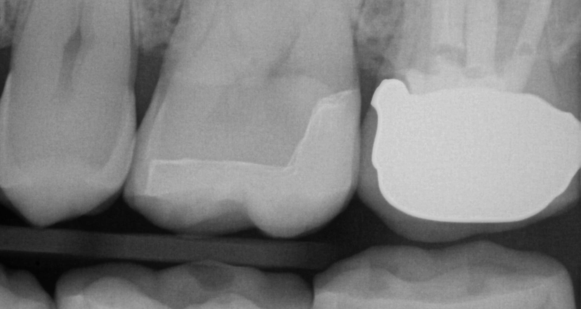 open margin pfm crown