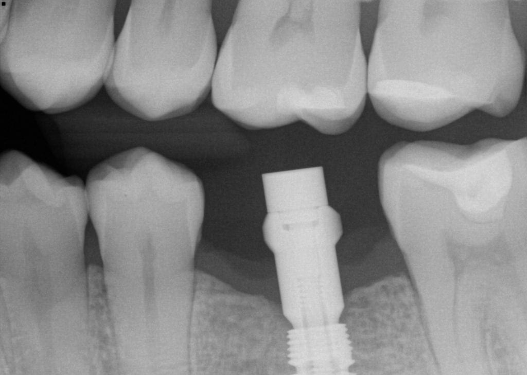 Proper Implant Placement and Digital Impressions with Scanbodies and
