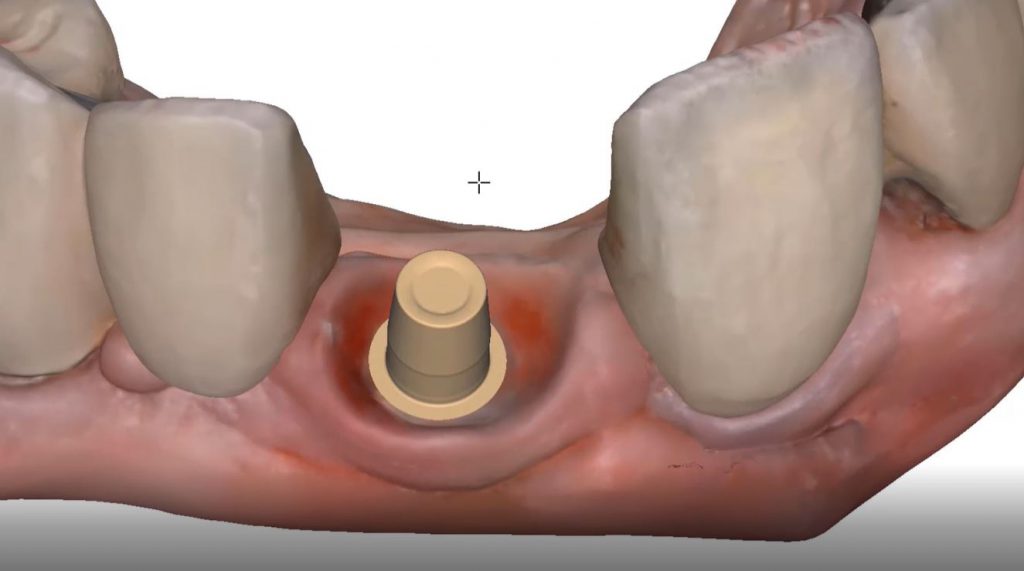 dental cerec